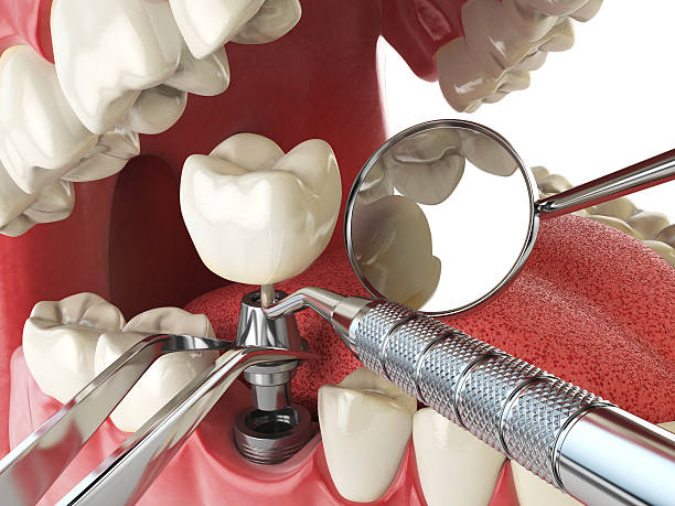 Best Emergency Denture Repair in Port Chester, NY